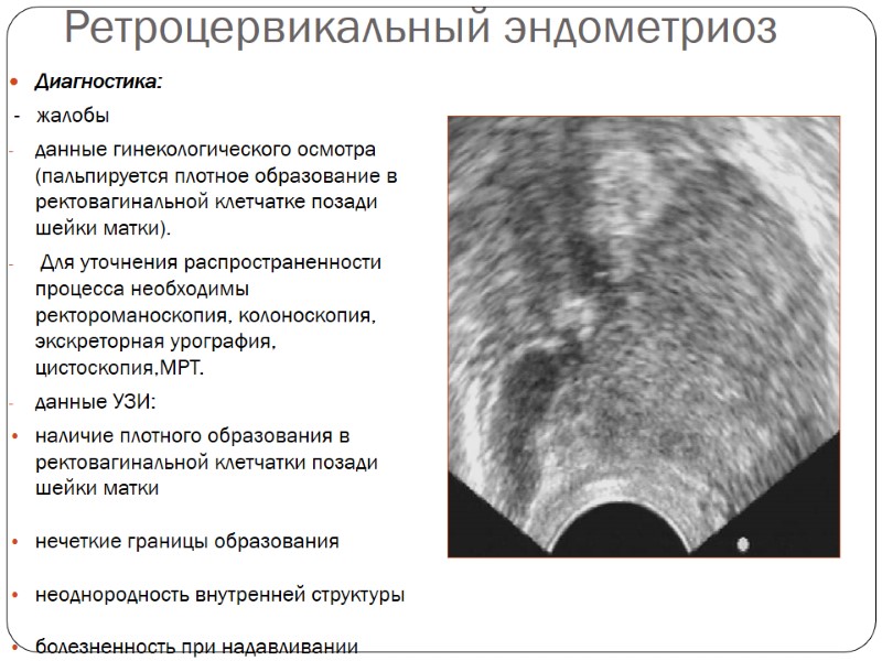 Ретроцервикальный эндометриоз Диагностика:  -   жалобы  данные гинекологического осмотра (пальпируется плотное